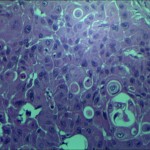 Fig 1- Células escamosas con alto grado nuclear y queratinización intracitoplasmática