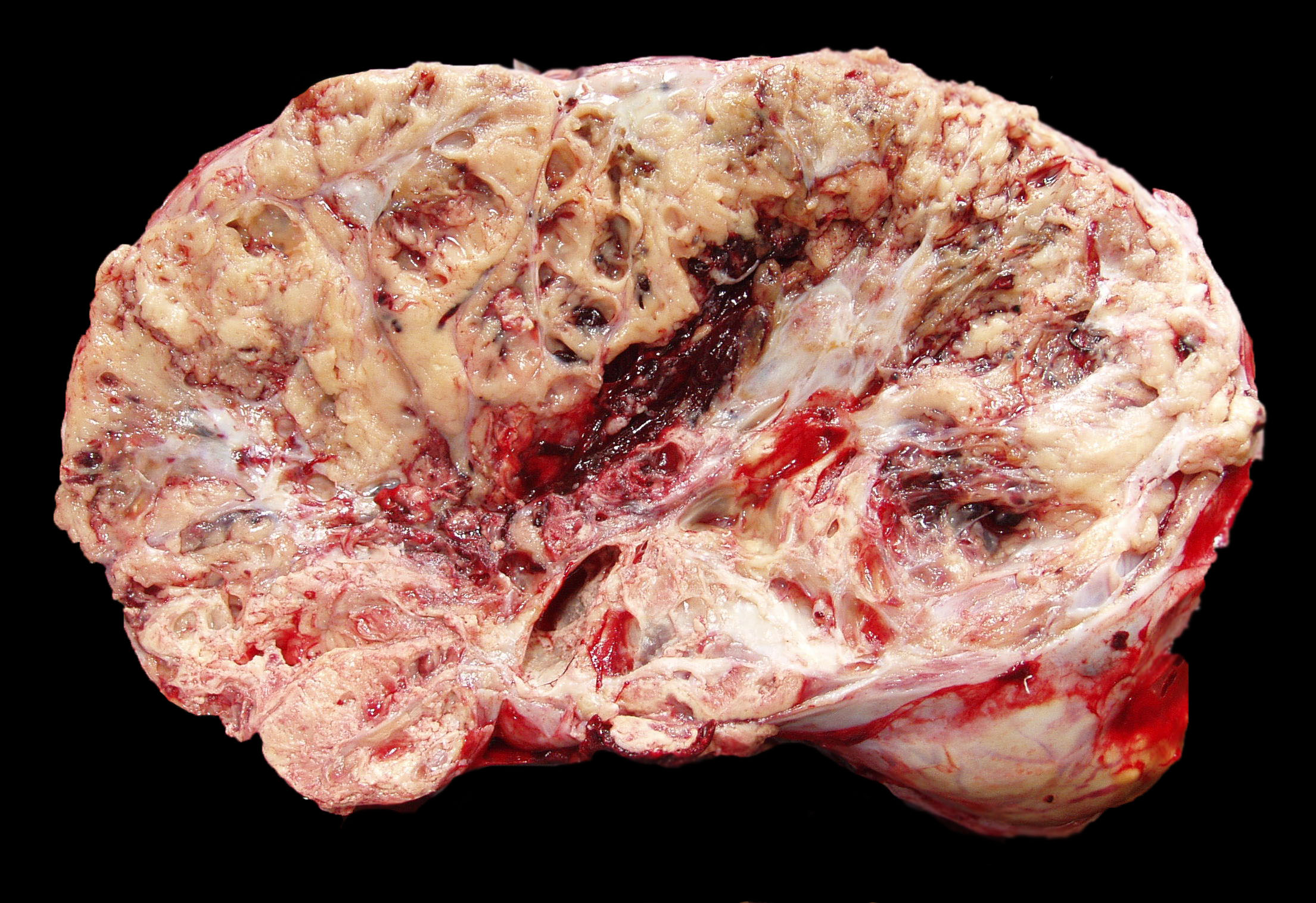 Tumor de células da granulosa do ovário - Sanar Medicina